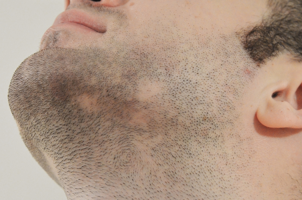 показания к пересадке бороды