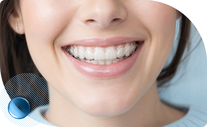 Как работает система 3D Smile
