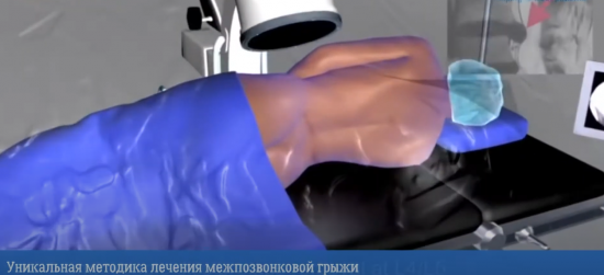 Эндоскопическое удаление грыжи | Уникальный метод лечения