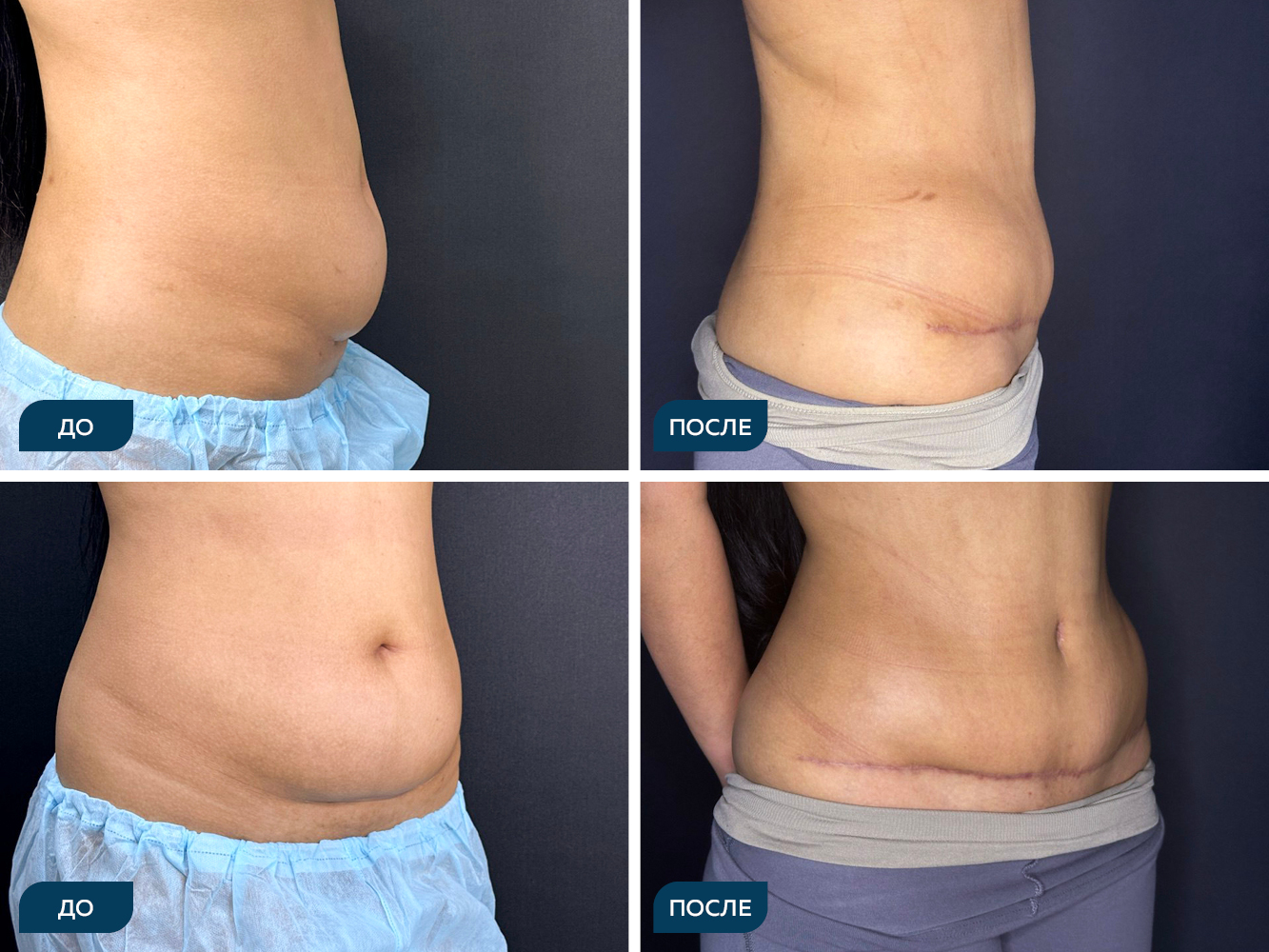 Классическая абдоминопластика с перемещением пупка и ушиванием прямых мышц