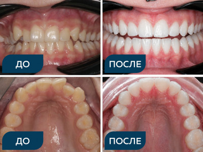 Скученность, вестибулоположение клыков, кривая Шпее.