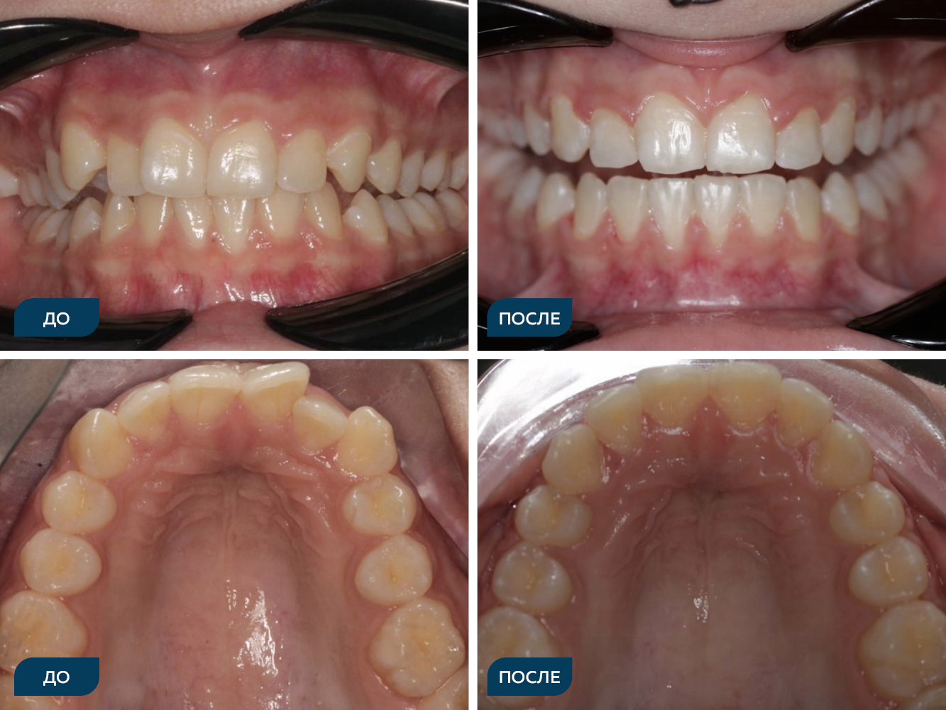 Скученность, вестибулоположение клыков, кривая Шпее.