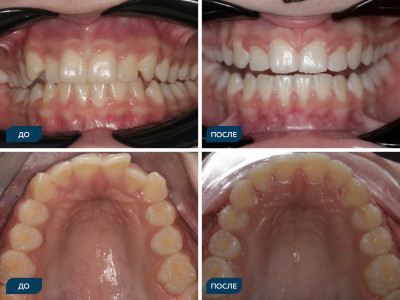 Скученность, вестибулоположение клыков, кривая Шпее.