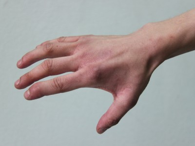 Синдром Льюиса-Самнера