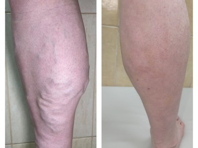 Варикозное расширение БПВ, вены Джакомини и малой подкожной вены