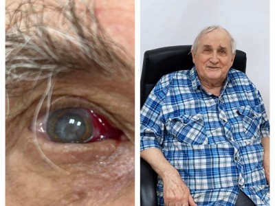 Операция по удалению катаракты