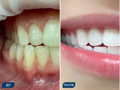 Офисное отбеливание зубов системой Opalescence кейс 4