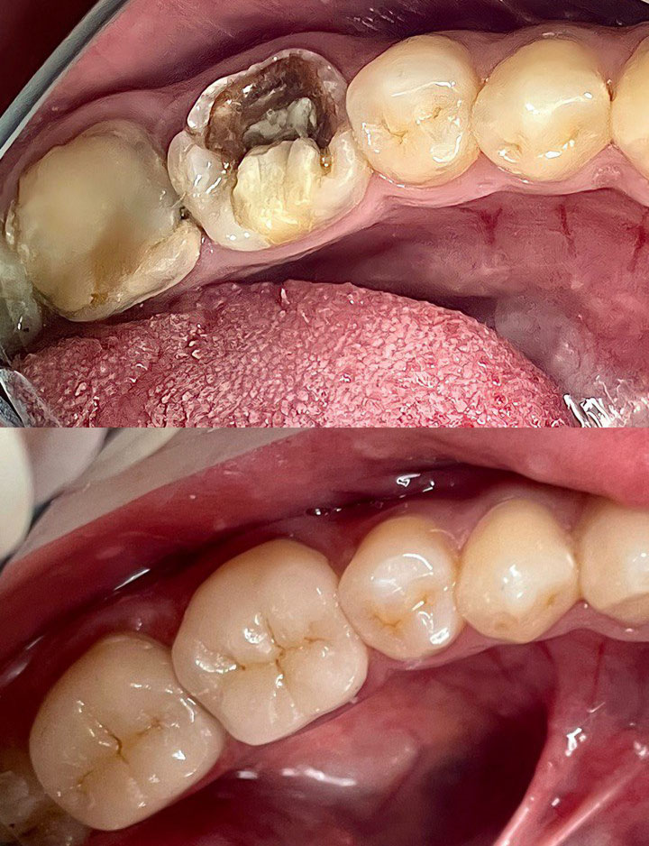 Восстановление зуба с помощью керамической накладки