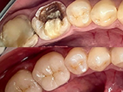 Восстановление зуба с помощью керамической накладки