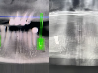 Удаление зубов с одномоментной имплантацией