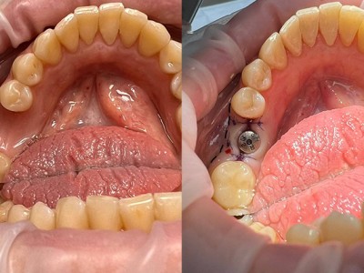 Установка имплантата с десневой пластикой