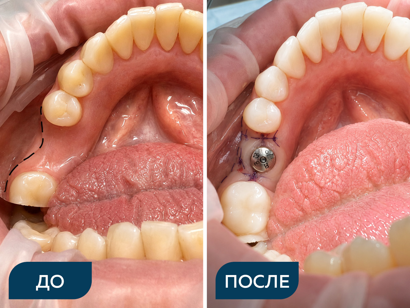 Установка имплантата с десневой пластикой
