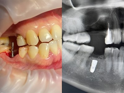 Удаление зуба с одномоментной имплантацией
