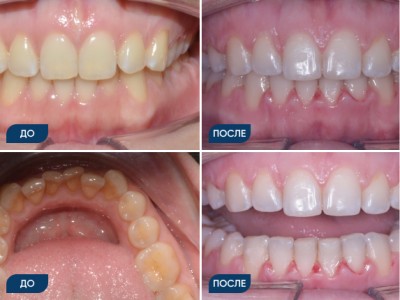 Ортодонтическое лечение на брекет-системе кейс 2