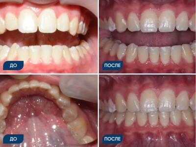 Ортодонтическое лечение на брекет-системе кейс 3