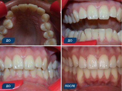 Ортодонтическое лечение на брекет-системе кейс 4