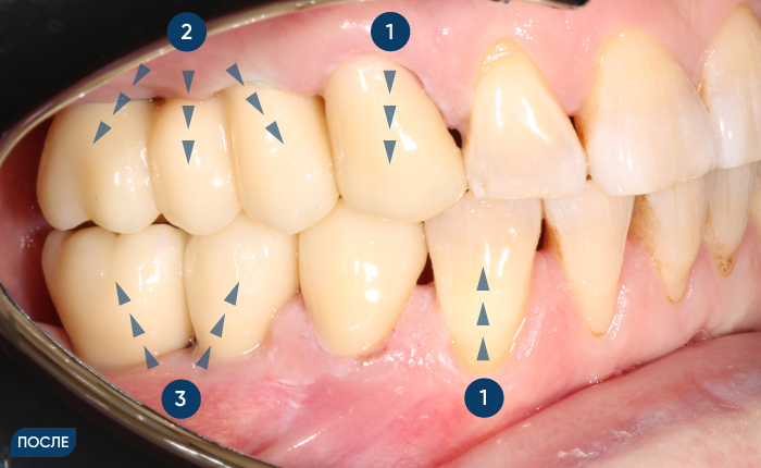 Установка коронок и моста на собственные зубы и на импланты