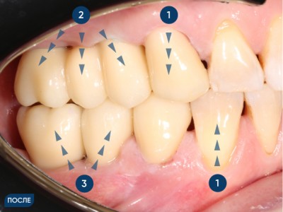 Установка коронок и моста на собственные зубы и на импланты
