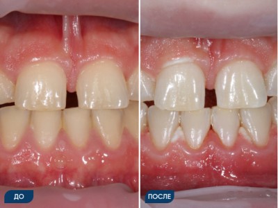 Офисное отбеливание зубов системой Opalescence кейс 1