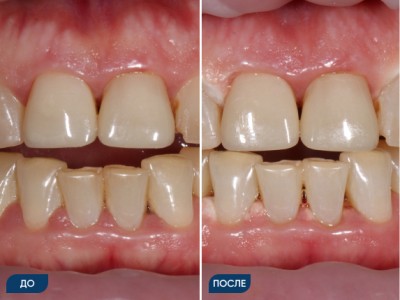 Офисное отбеливание зубов системой Opalescence кейс 2