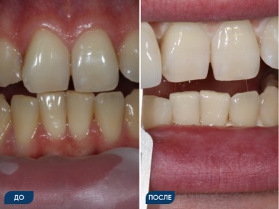 Офисное отбеливание зубов системой Opalescence кейс 3