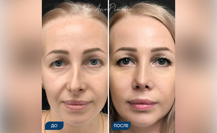 Риносептопластика