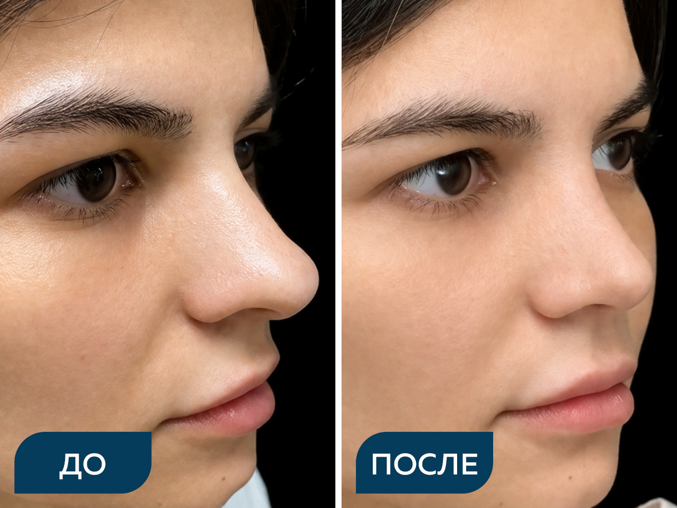Риносептопластика