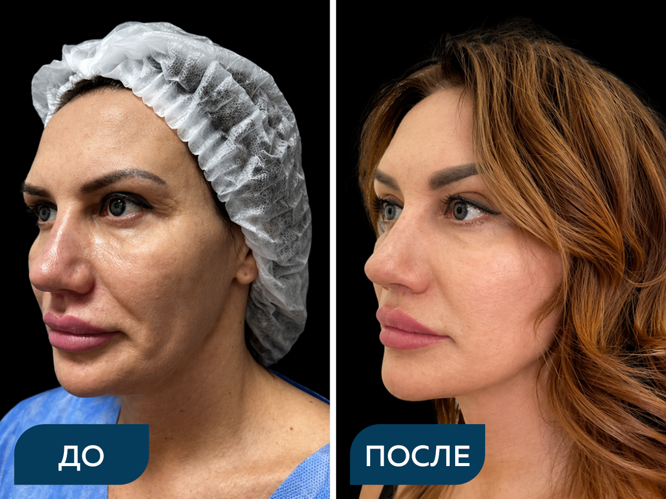 Подтяжка лба и бровей, лица и шеи