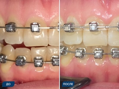 Ортодонтическое лечение на брекет-системе кейс 1