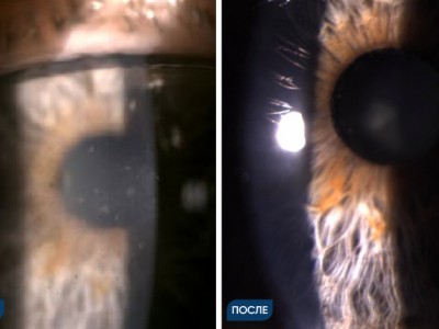 Лечение герпетического кератоиридоциклита