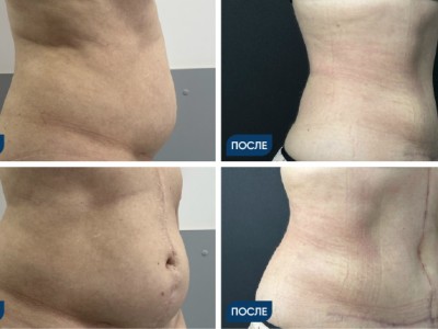 Классическая абдоминопластика с перемещением пупка, ушиванием прямых мышц и липосакция