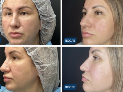 Блефаропластика верхних и нижних век кейс 5