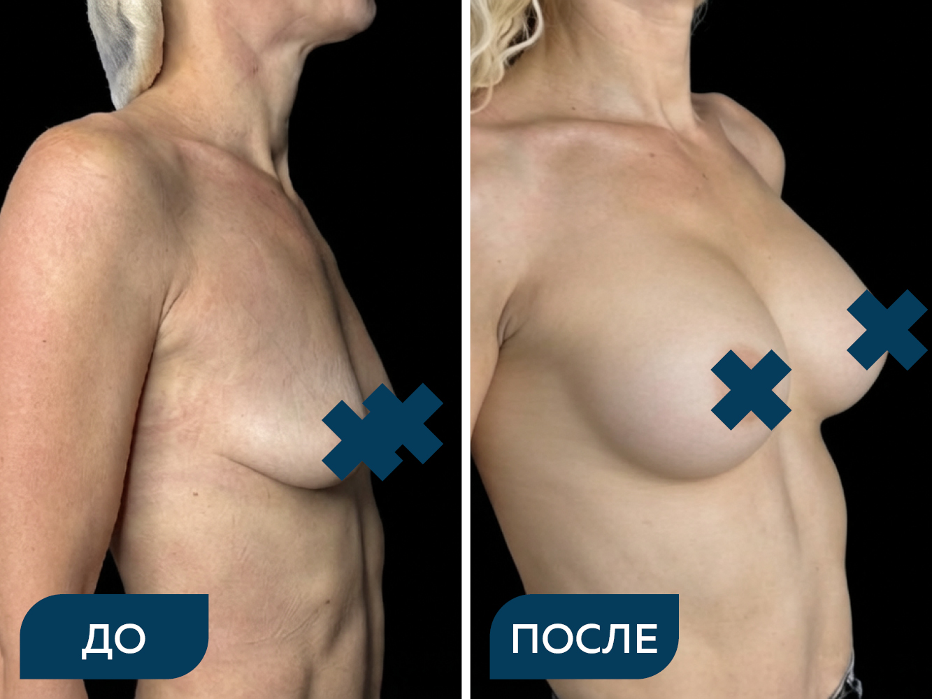 Увеличение груди кейс 1