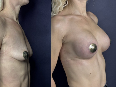 Увеличение груди кейс 1