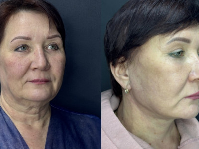 SMAS- лифтинг кейс 1