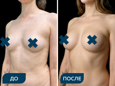 Увеличение груди и подтяжка бедер кейс 1
