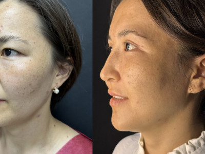 Азиатская блефаропластика кейс 1