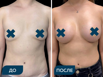 Увеличение груди кейс 2