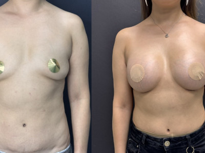 Увеличение груди кейс 2