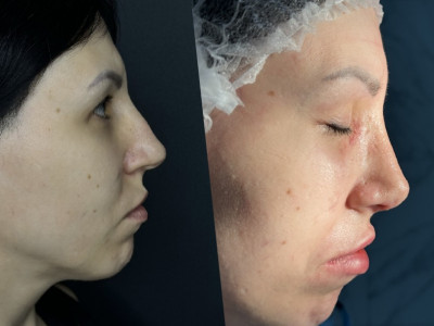 Ринопластика кейс 1