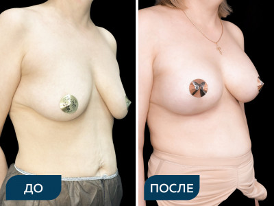 Мамопластика с имплантами
