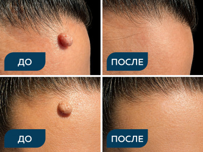 Внутридермальный меланоцитарный невус