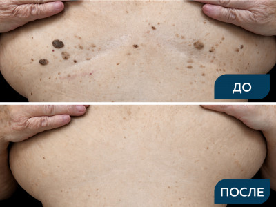 Себорейный кератоз