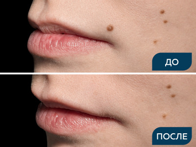 Удаление внутридермального пигментированного невуса над верхней губой