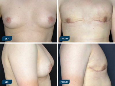 Коррекция смешанной формы гинекомастии