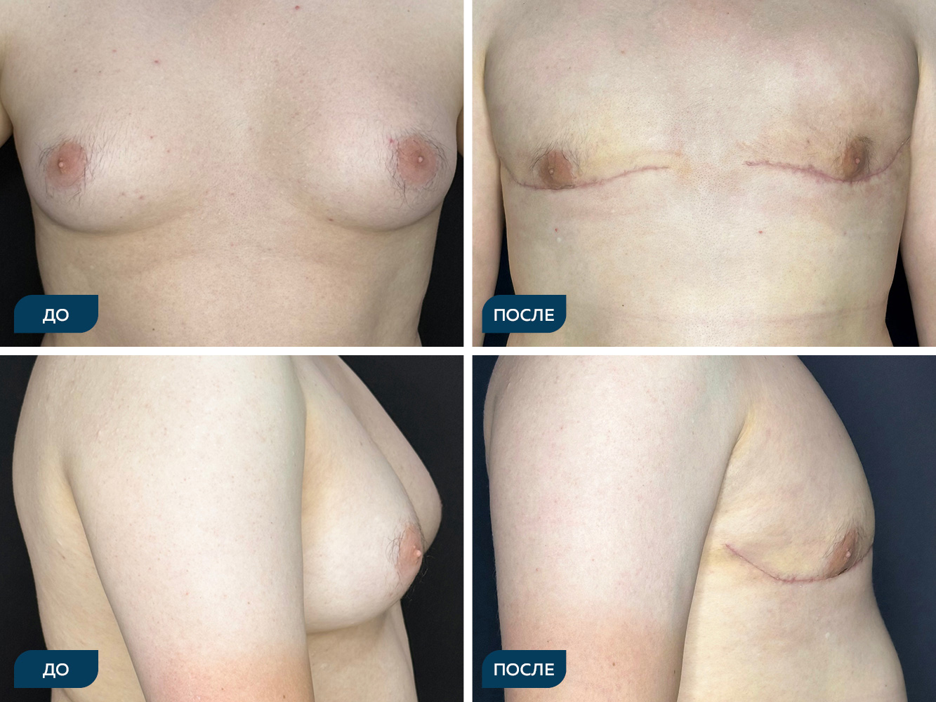 Коррекция смешанной формы гинекомастии