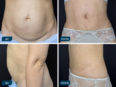 Абдоминопластика с ушиванием диастаза, кейс 4