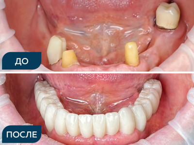 Адентия жевательных сегментов.