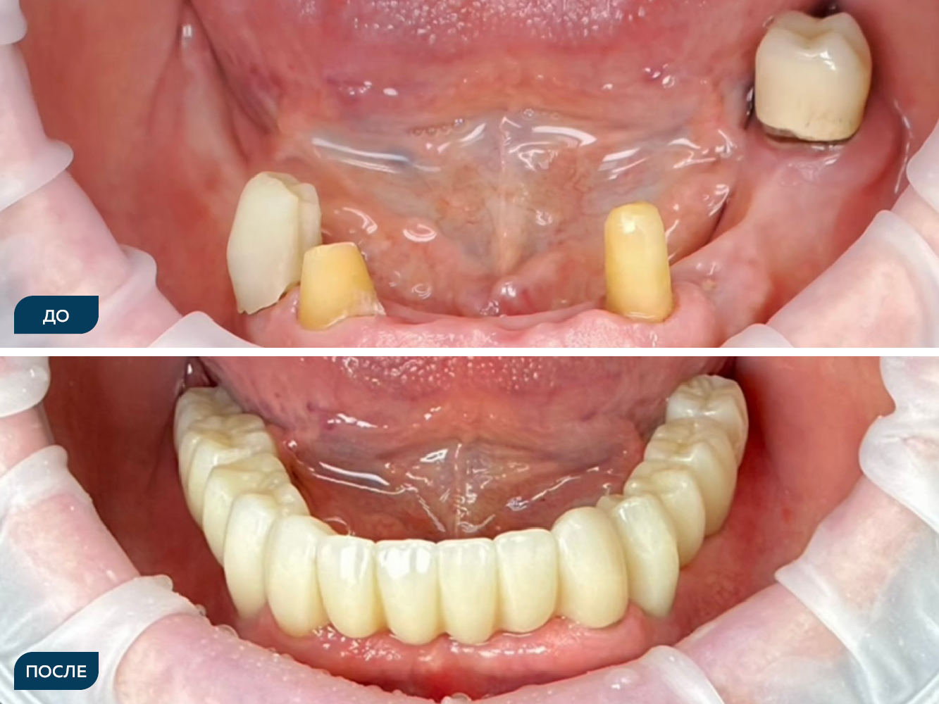 Сохранены отдельные зубы нижней челюсти (33, 43, 44, 37), в области 37— киста. Частичная адентия жевательных сегментов.