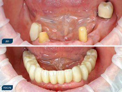 Сохранены отдельные зубы нижней челюсти (33, 43, 44, 37), в области 37— киста. Частичная адентия жевательных сегментов.